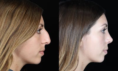 Rhinoplasty Before & After Gallery - Patient 370593 - Image 1