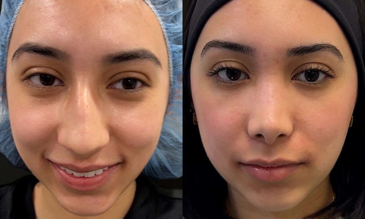 Rhinoplasty Before & After Gallery - Patient 220367 - Image 1