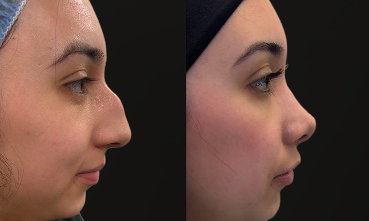 Rhinoplasty Before & After Gallery - Patient 220367 - Image 3