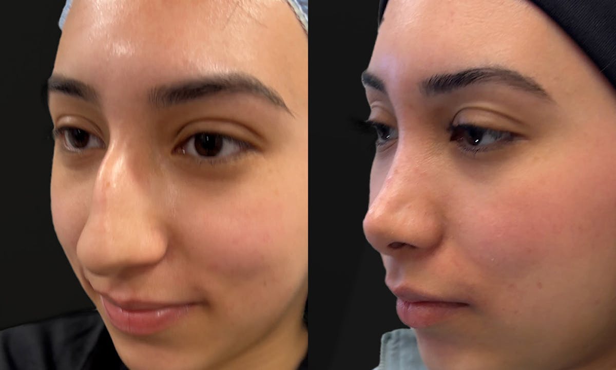 Rhinoplasty Before & After Gallery - Patient 220367 - Image 2