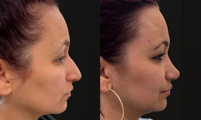 Rhinoplasty Before & After Gallery - Patient 575013 - Image 1