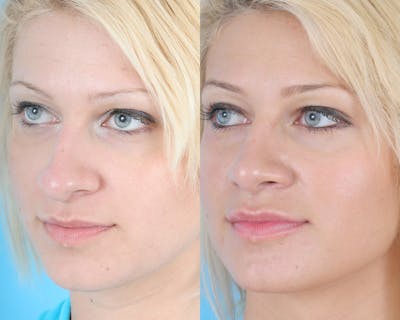 Rhinoplasty Before & After Gallery - Patient 308767 - Image 1