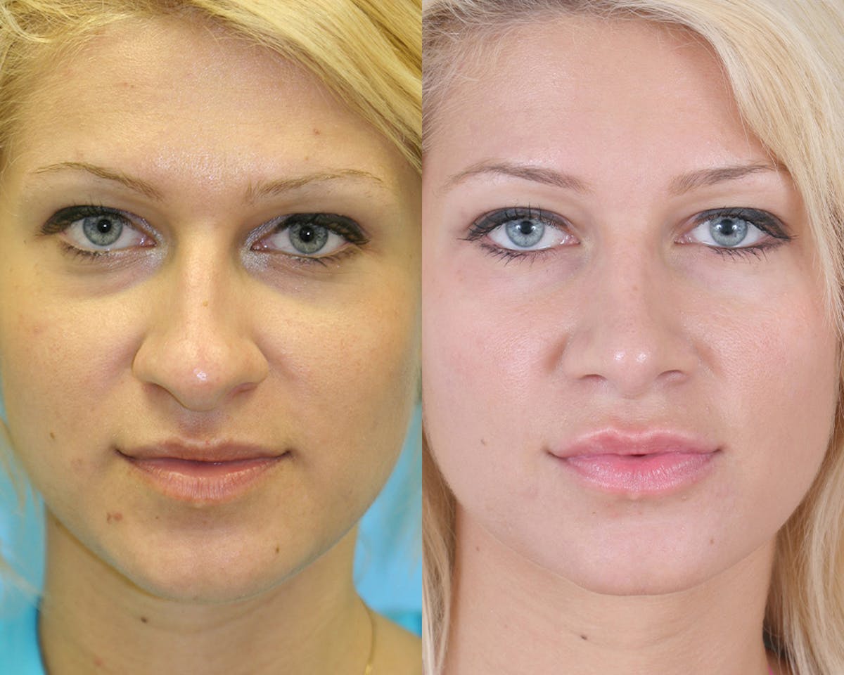 Rhinoplasty Before & After Gallery - Patient 308767 - Image 3