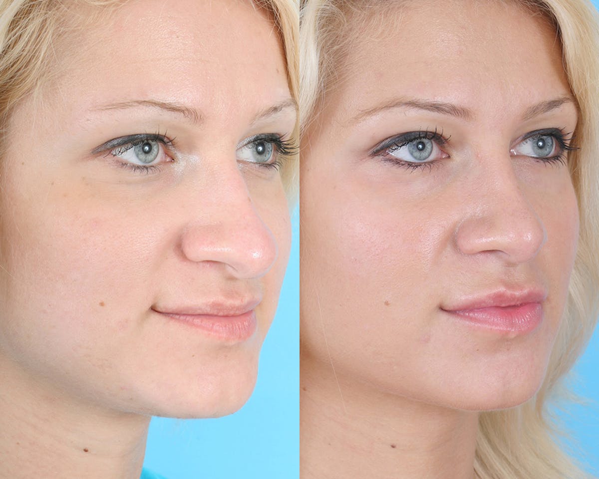 Rhinoplasty Before & After Gallery - Patient 308767 - Image 2