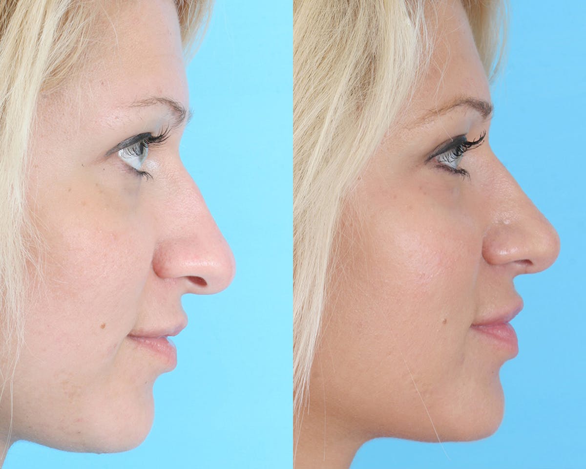 Rhinoplasty Before & After Gallery - Patient 308767 - Image 4
