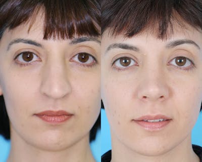 Rhinoplasty Before & After Gallery - Patient 907755 - Image 1