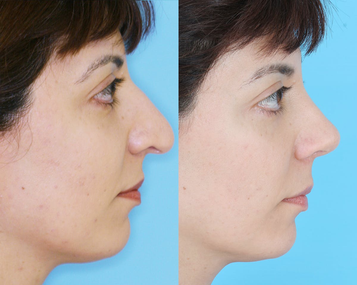 Rhinoplasty Before & After Gallery - Patient 907755 - Image 3