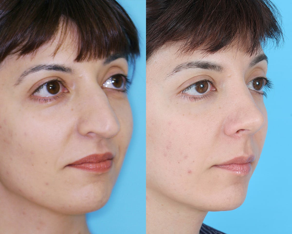 Rhinoplasty Before & After Gallery - Patient 907755 - Image 2