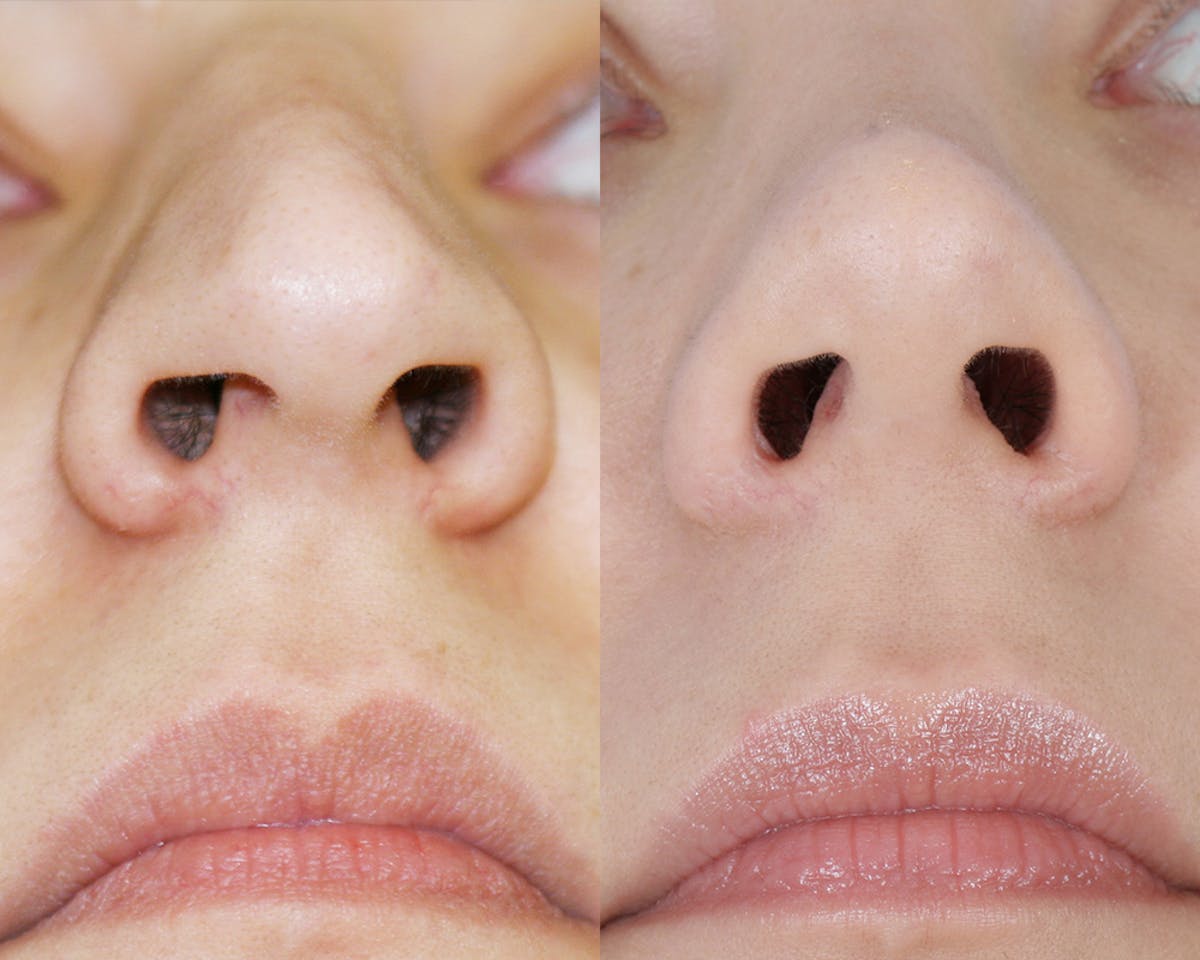 Rhinoplasty Before & After Gallery - Patient 907755 - Image 4