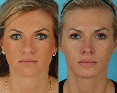 Rhinoplasty Before & After Gallery - Patient 145617 - Image 1