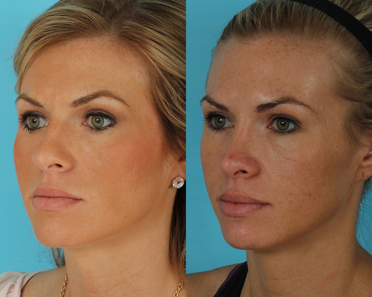 Rhinoplasty Before & After Gallery - Patient 145617 - Image 3