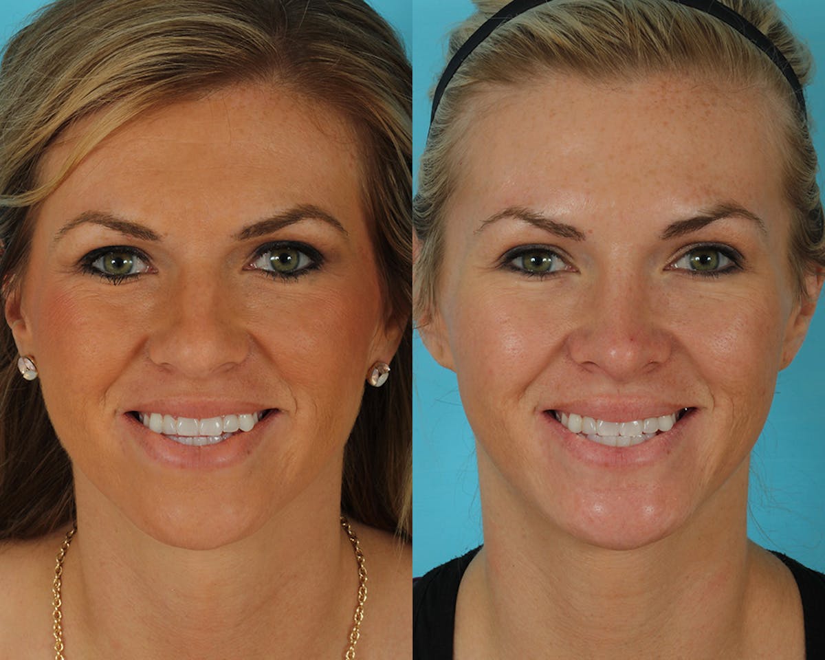 Rhinoplasty Before & After Gallery - Patient 145617 - Image 2