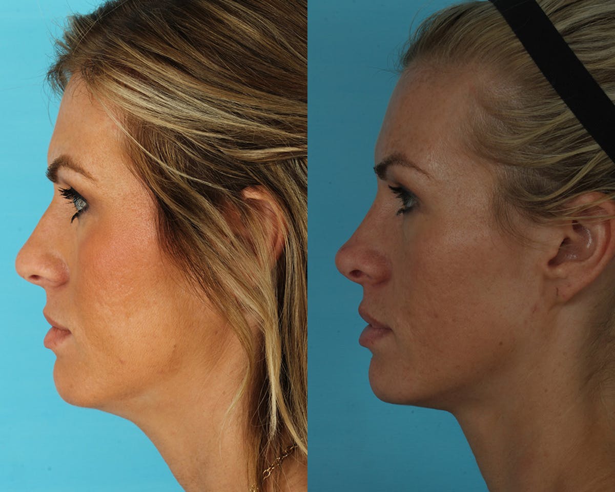 Rhinoplasty Before & After Gallery - Patient 145617 - Image 4