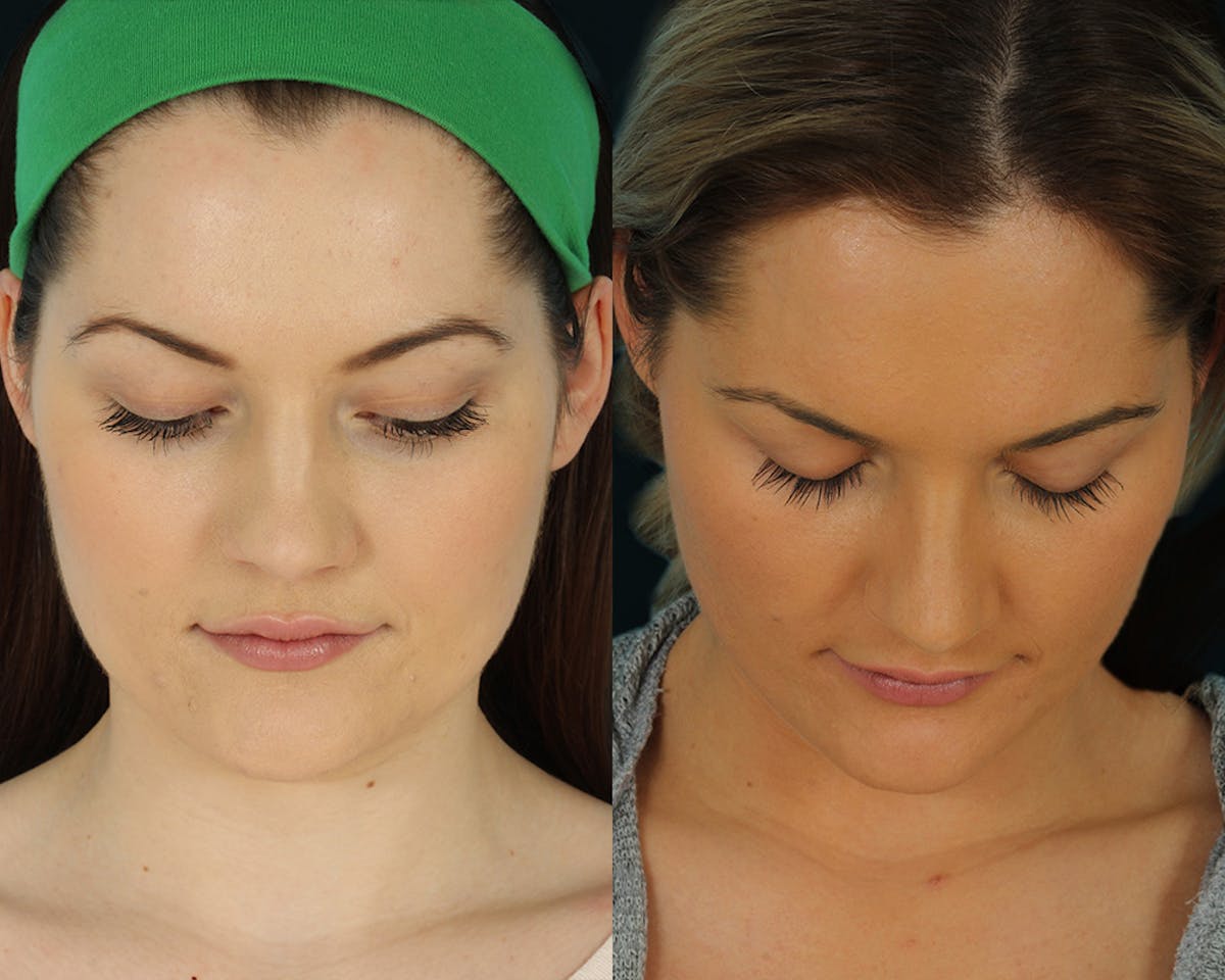 Rhinoplasty Before & After Gallery - Patient 472874 - Image 3