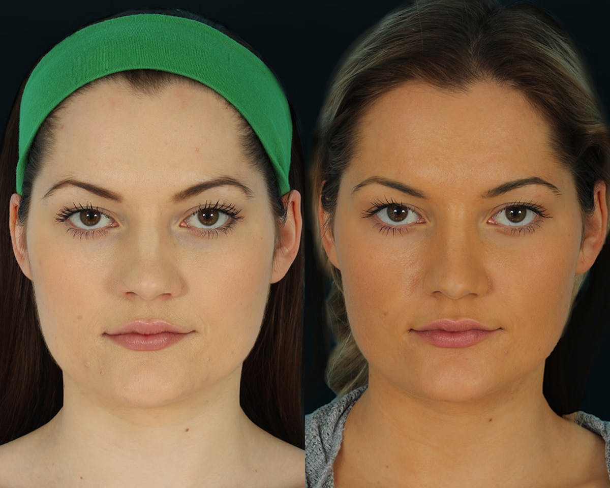 Rhinoplasty Before & After Gallery - Patient 472874 - Image 2