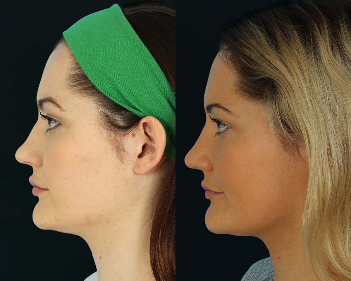 Rhinoplasty Before & After Gallery - Patient 472874 - Image 4