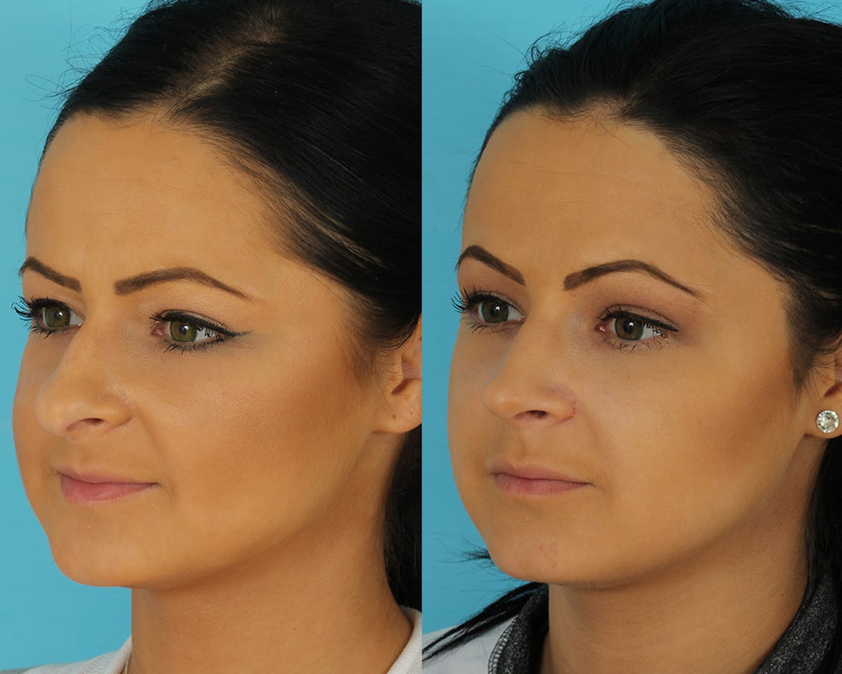 Rhinoplasty Before & After Gallery - Patient 297450 - Image 1