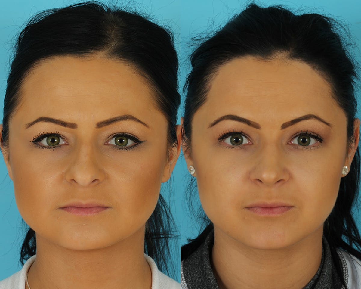 Rhinoplasty Before & After Gallery - Patient 297450 - Image 3