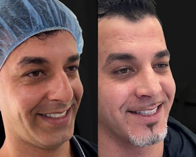Rhinoplasty Before & After Gallery - Patient 156288 - Image 1