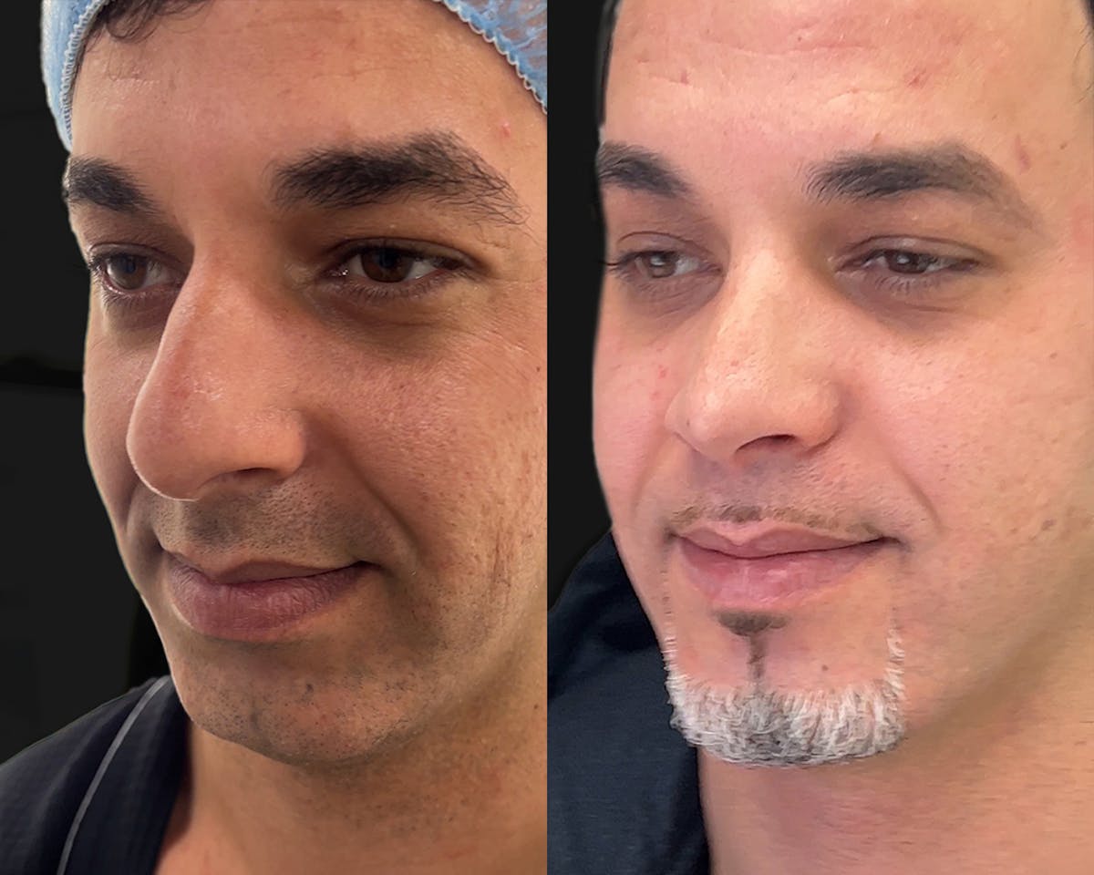 Rhinoplasty Before & After Gallery - Patient 156288 - Image 2