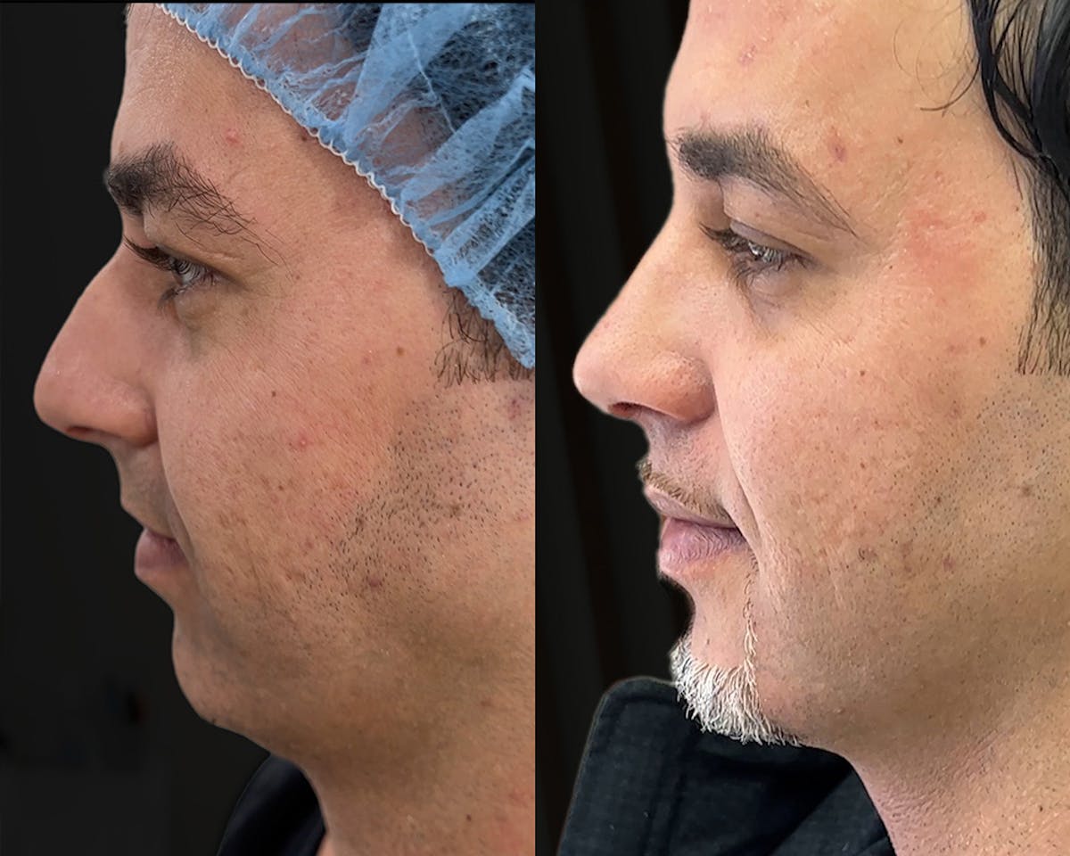 Rhinoplasty Before & After Gallery - Patient 156288 - Image 3