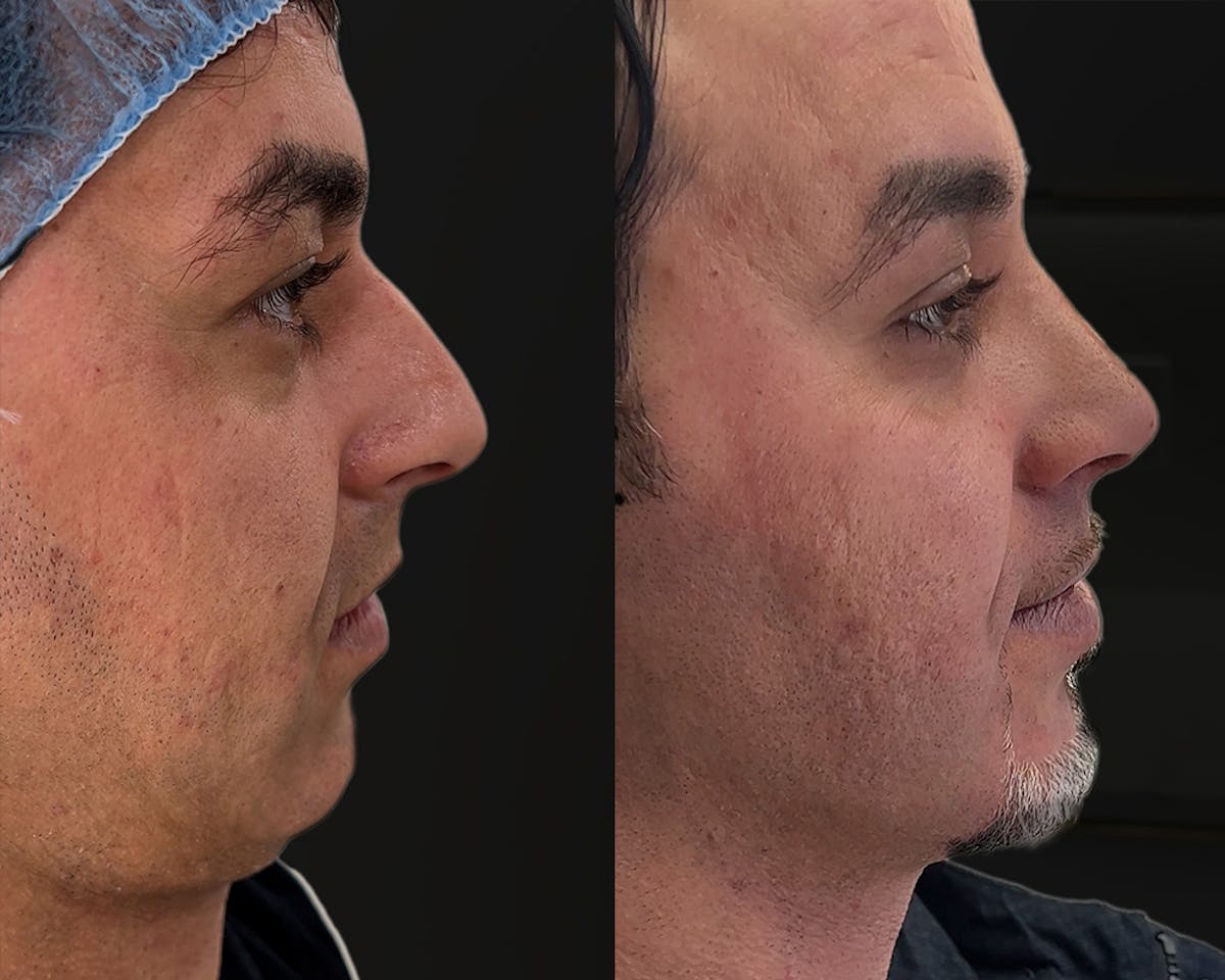 Rhinoplasty Before & After Gallery - Patient 156288 - Image 4