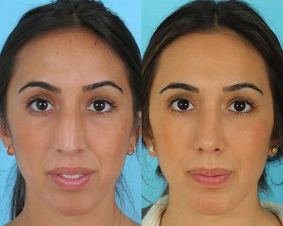 Rhinoplasty Before & After Gallery - Patient 235890 - Image 1