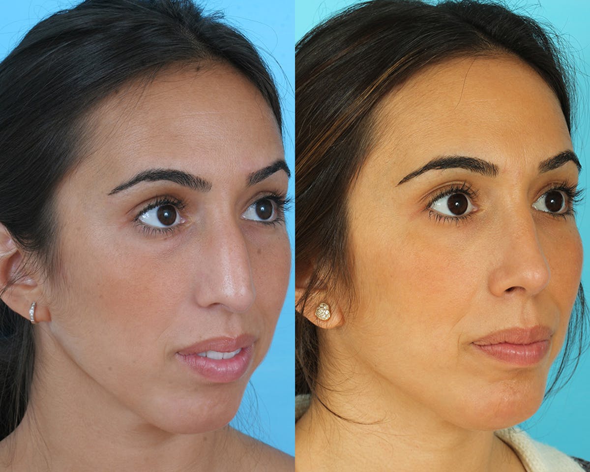 Rhinoplasty Before & After Gallery - Patient 235890 - Image 2