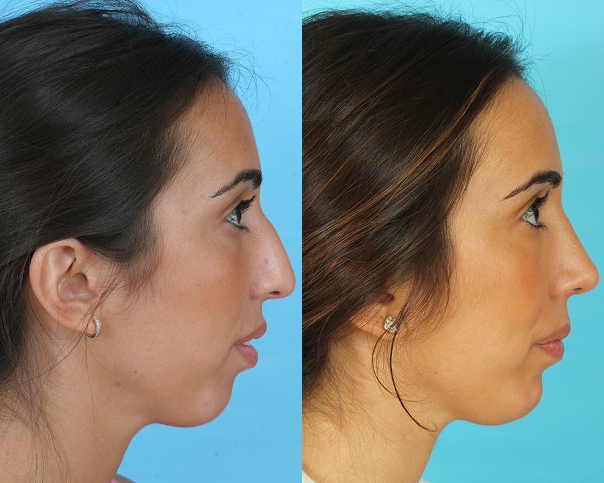 Rhinoplasty Before & After Gallery - Patient 235890 - Image 3