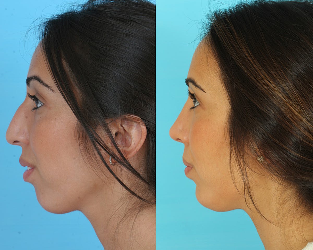 Rhinoplasty Before & After Gallery - Patient 235890 - Image 4