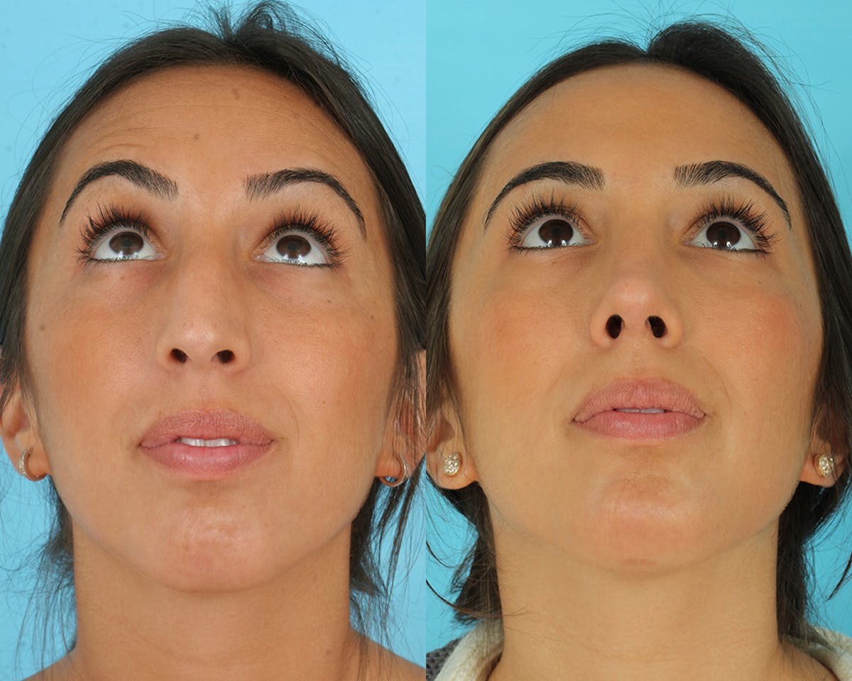 Rhinoplasty Before & After Gallery - Patient 235890 - Image 5