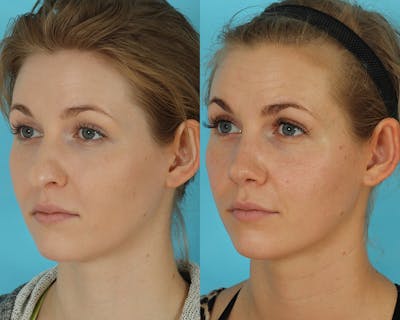 Rhinoplasty Before & After Gallery - Patient 238537 - Image 1