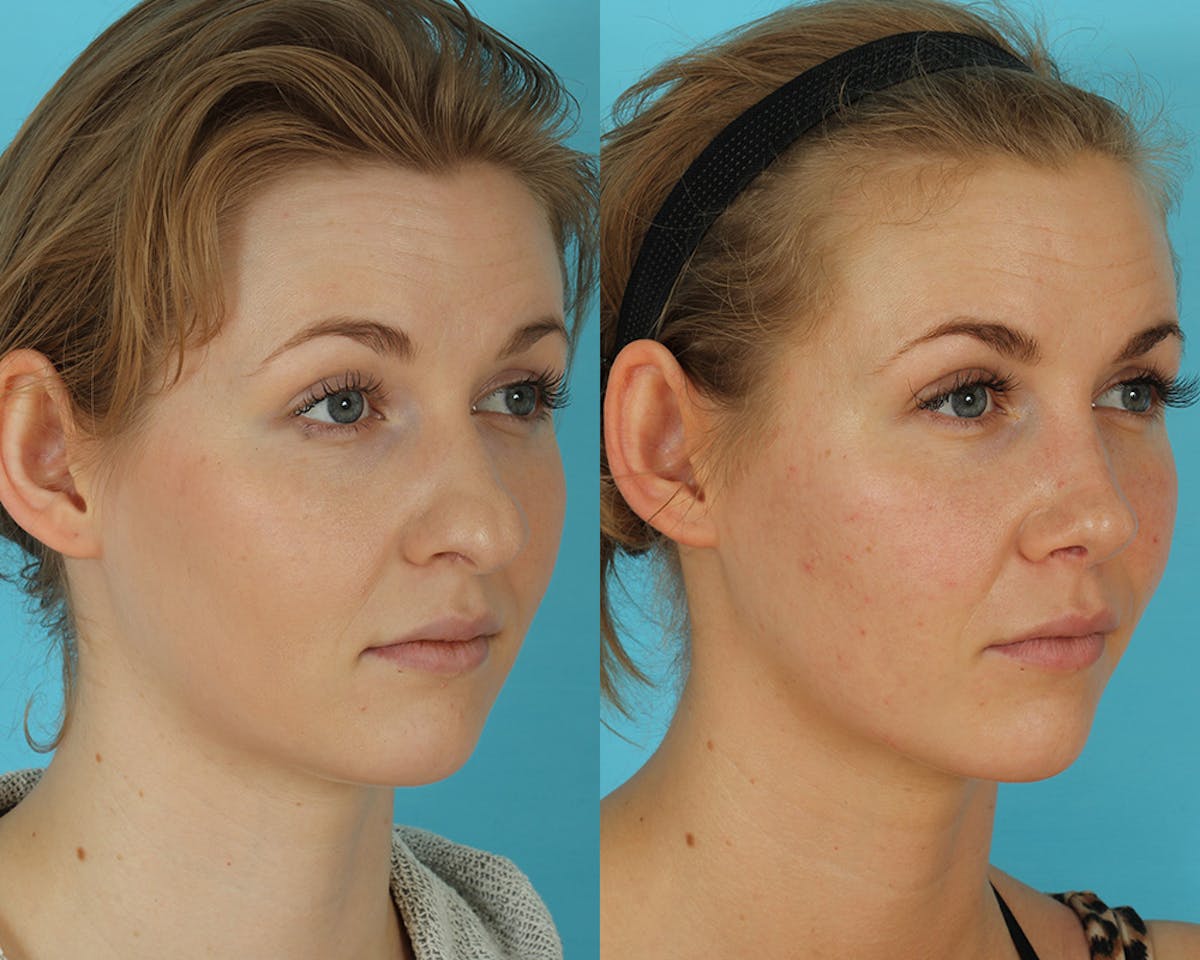 Rhinoplasty Before & After Gallery - Patient 238537 - Image 2