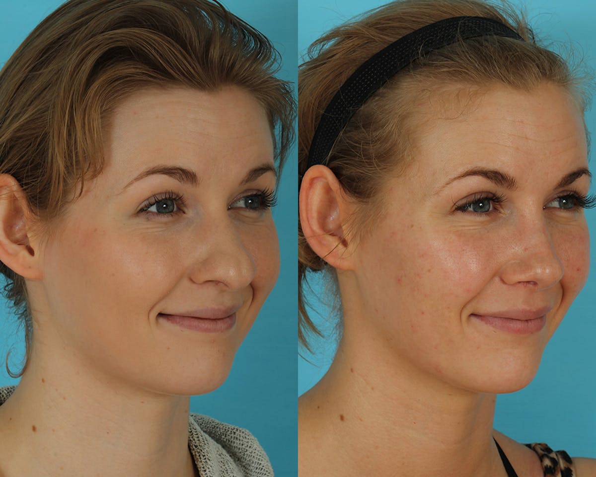 Rhinoplasty Before & After Gallery - Patient 238537 - Image 3