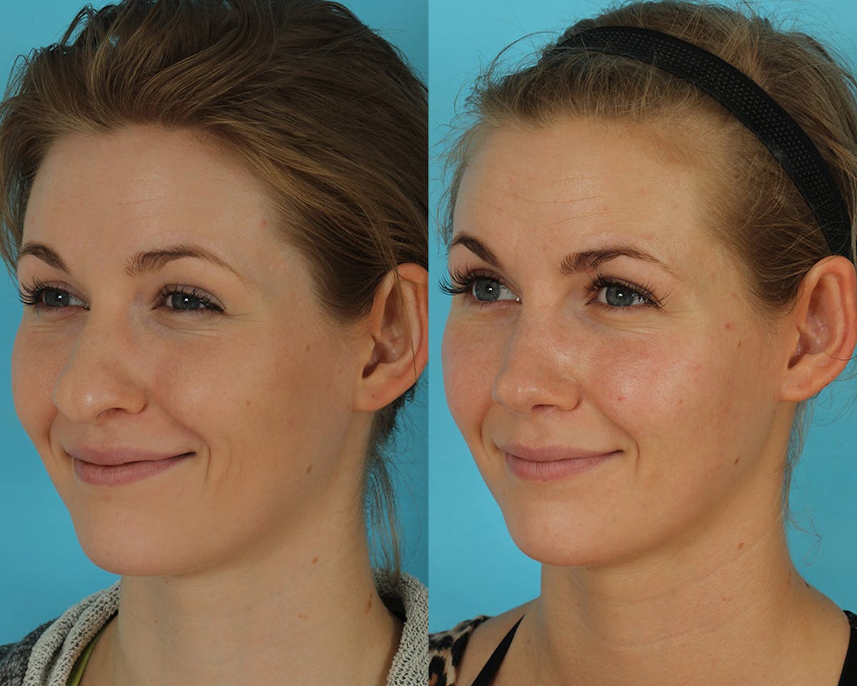 Rhinoplasty Before & After Gallery - Patient 238537 - Image 4