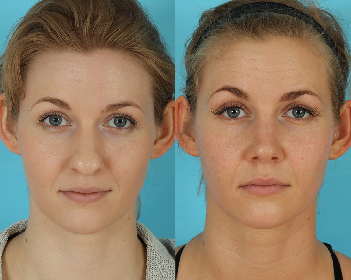 Rhinoplasty Before & After Gallery - Patient 238537 - Image 5