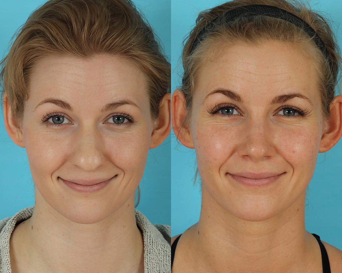 Rhinoplasty Before & After Gallery - Patient 238537 - Image 6