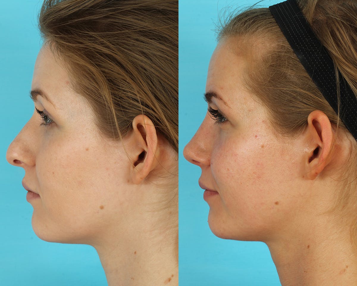 Rhinoplasty Before & After Gallery - Patient 238537 - Image 7