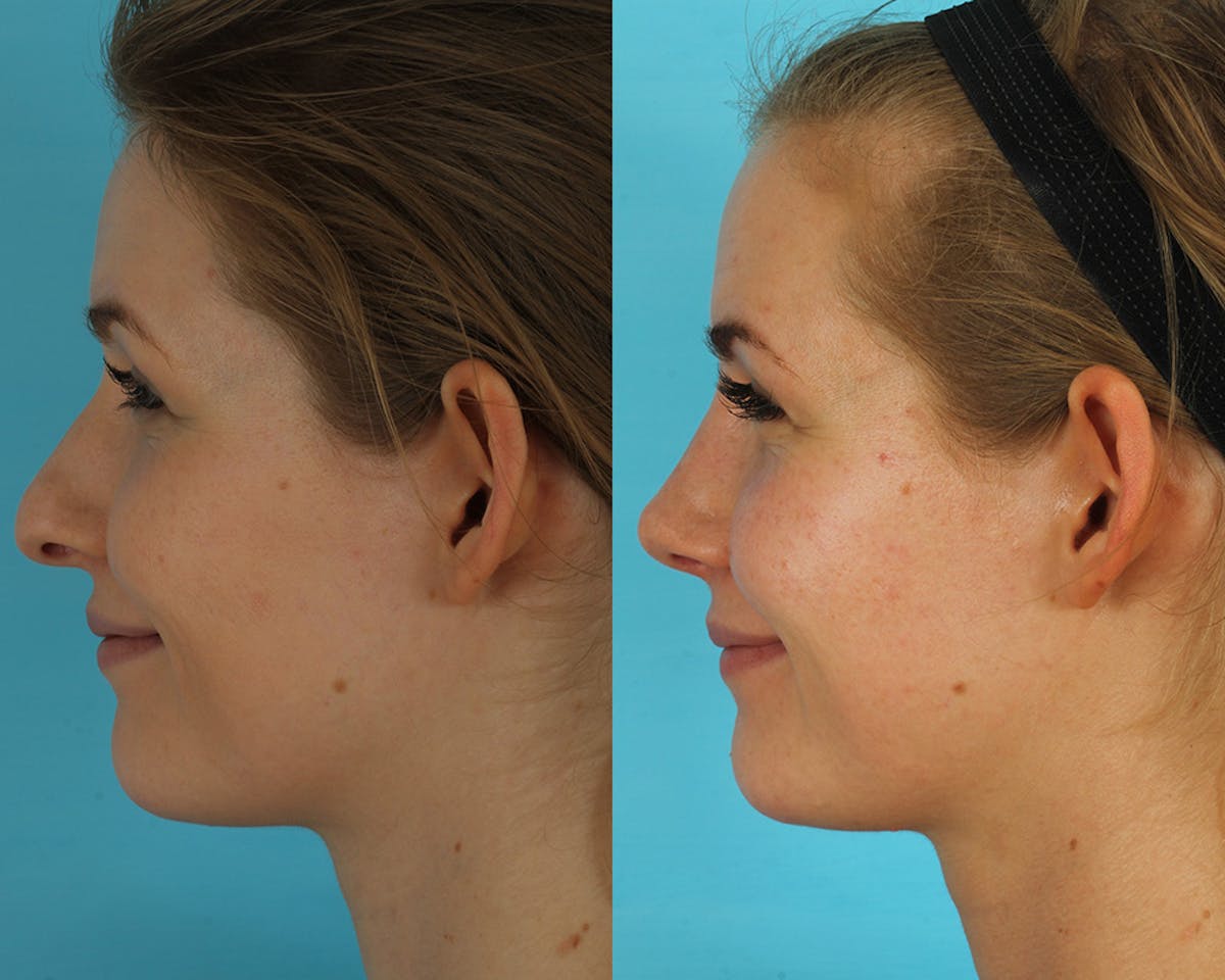 Rhinoplasty Before & After Gallery - Patient 238537 - Image 8