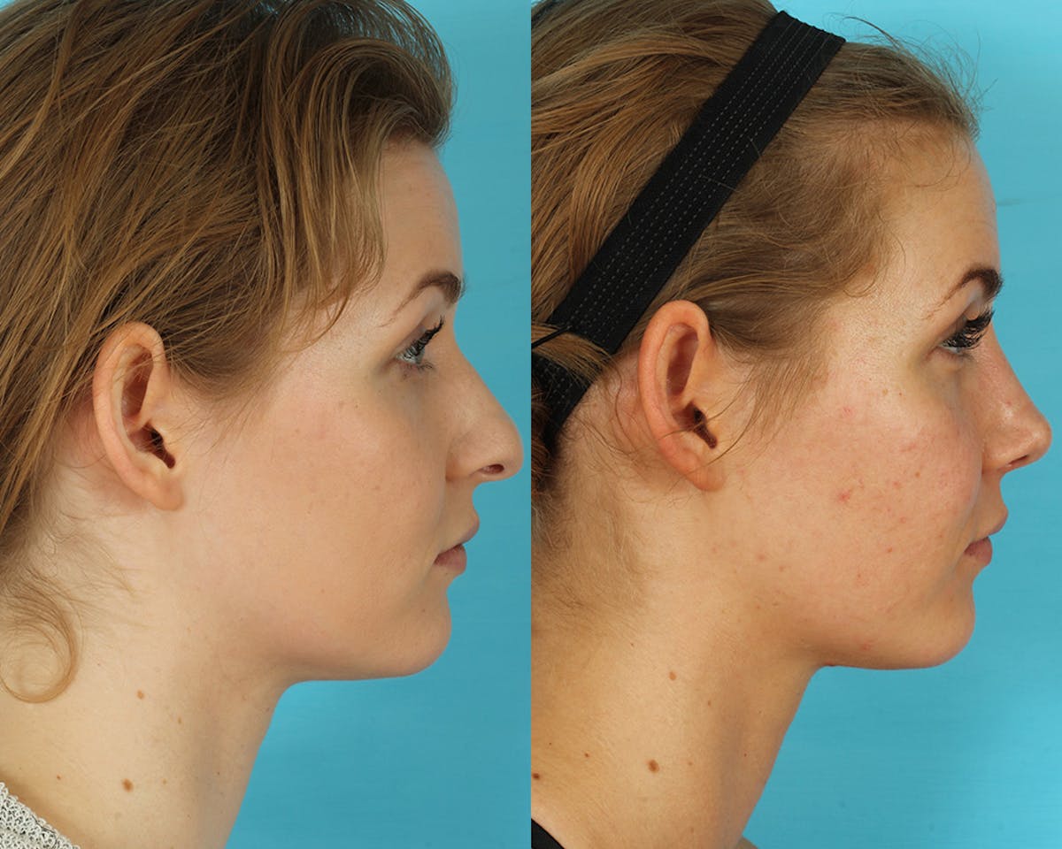 Rhinoplasty Before & After Gallery - Patient 238537 - Image 9