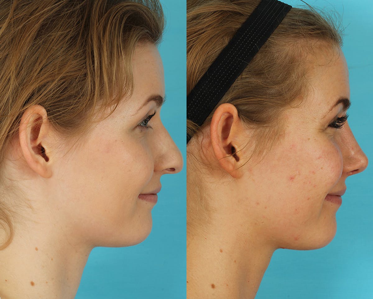 Rhinoplasty Before & After Gallery - Patient 238537 - Image 10