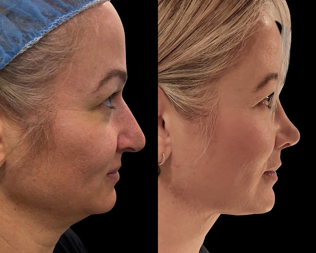 Rhinoplasty Before & After Gallery - Patient 403621 - Image 2