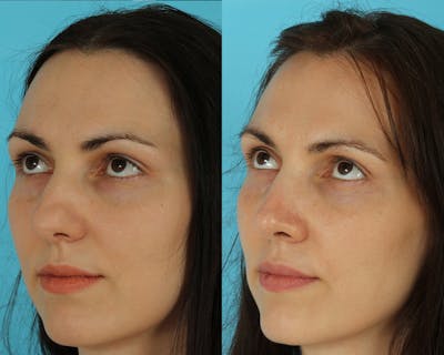 Rhinoplasty Before & After Gallery - Patient 297671 - Image 1