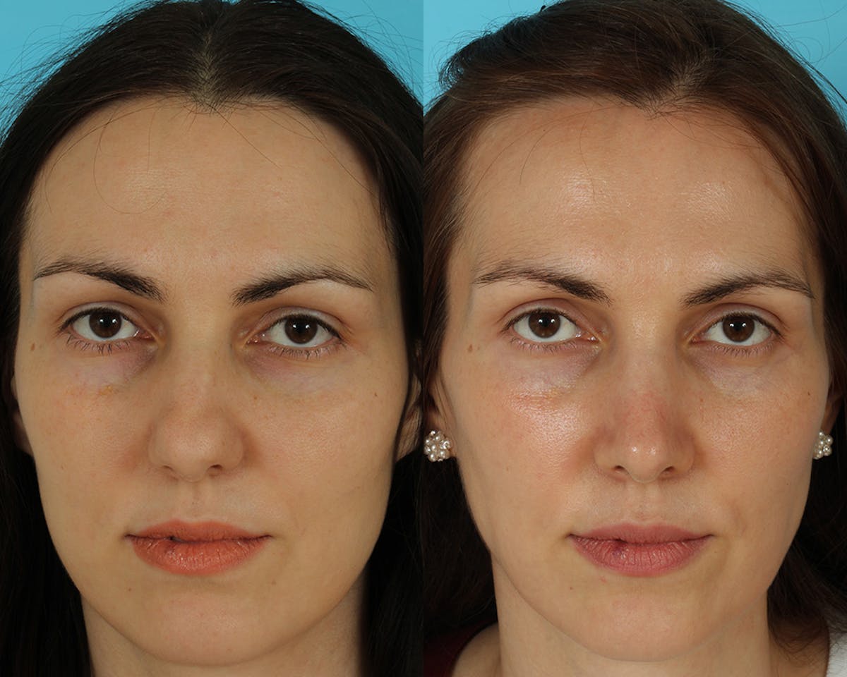 Rhinoplasty Before & After Gallery - Patient 297671 - Image 3