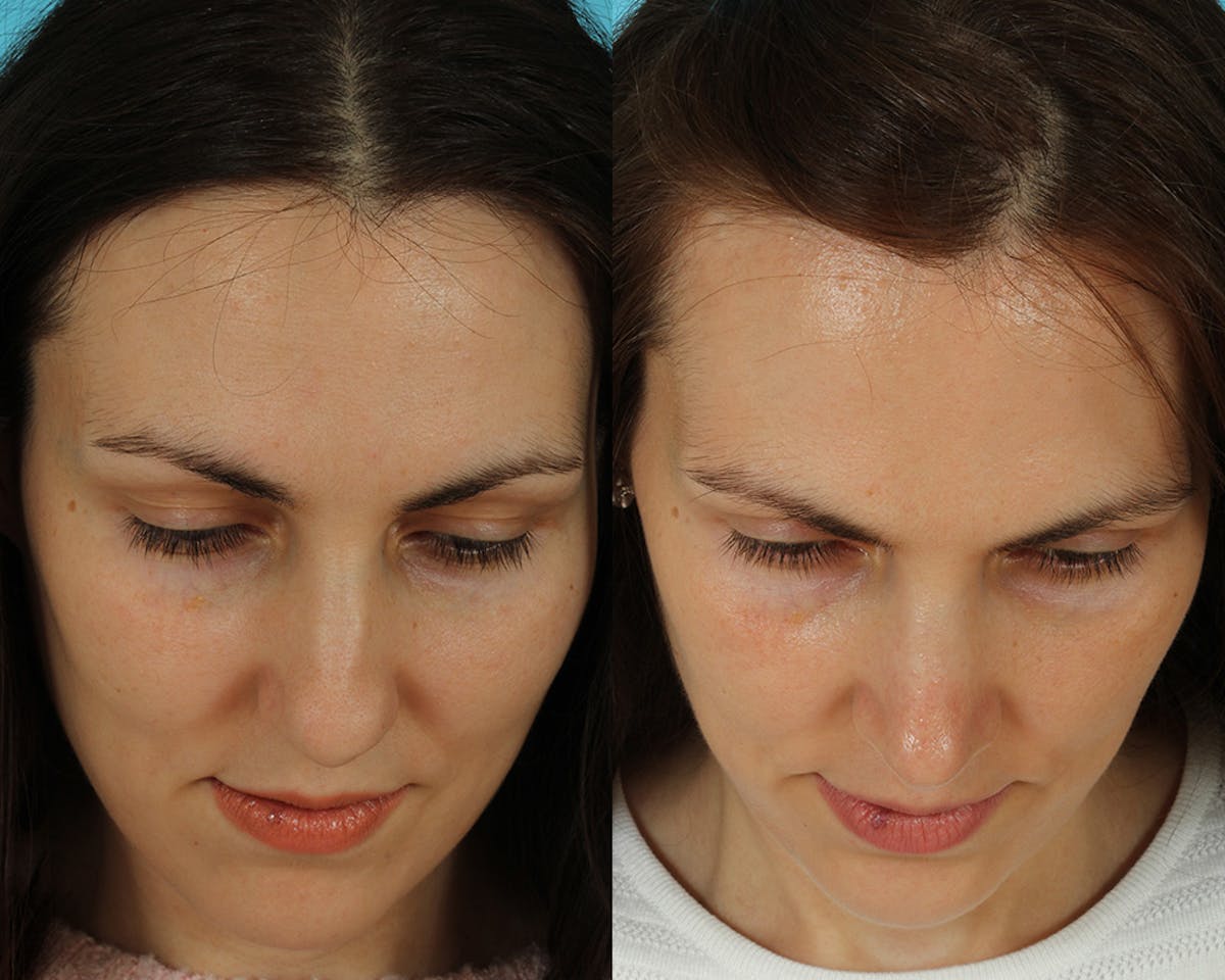 Rhinoplasty Before & After Gallery - Patient 297671 - Image 2