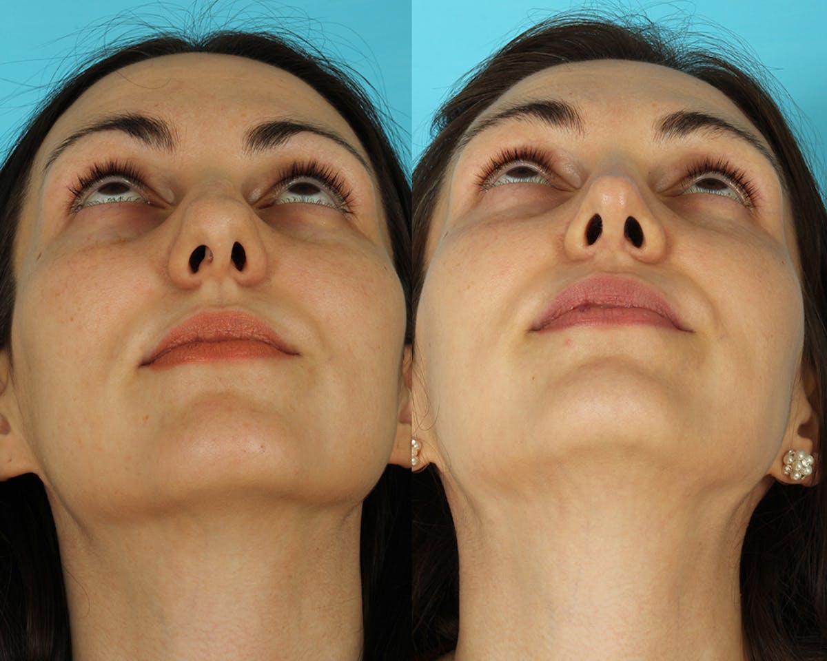 Rhinoplasty Before & After Gallery - Patient 297671 - Image 6