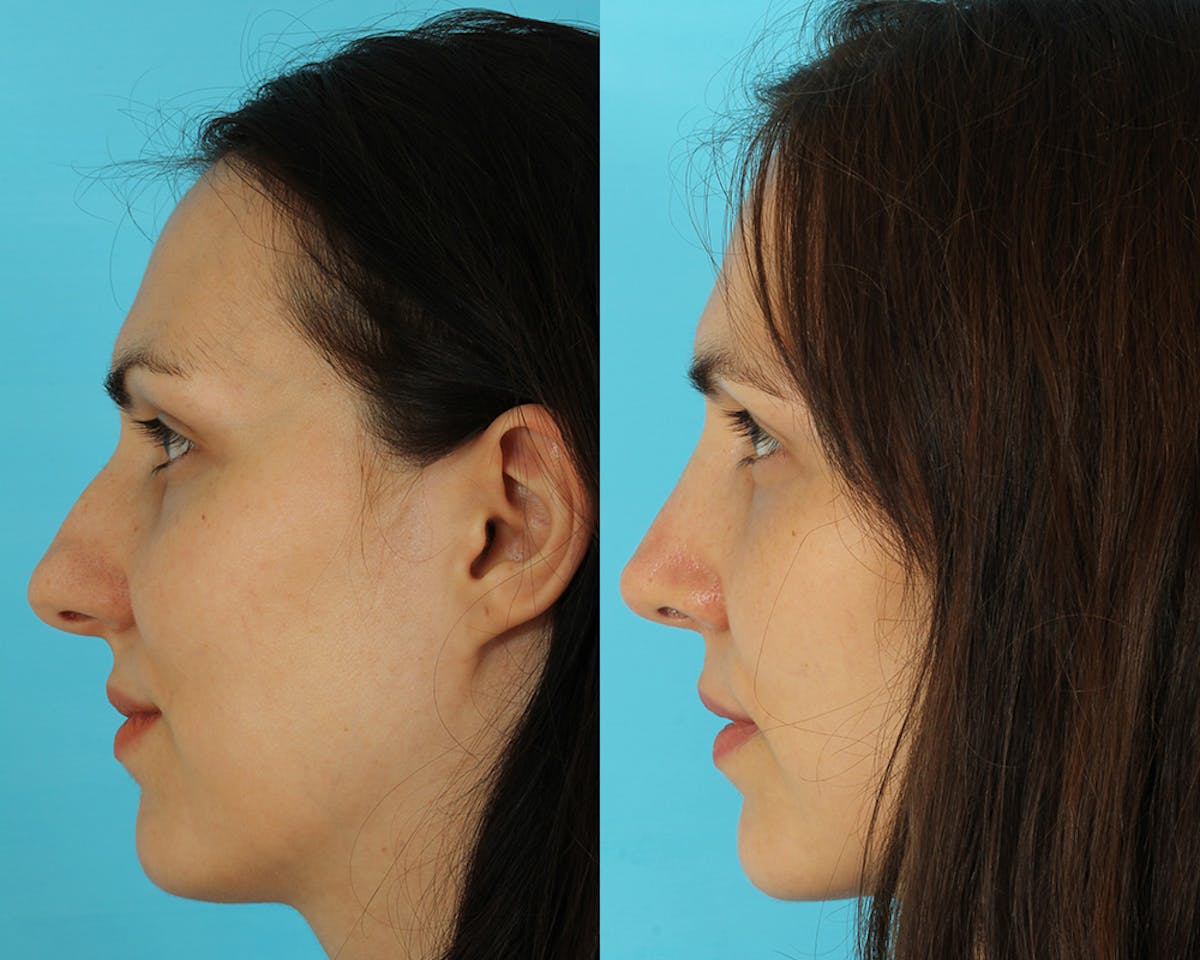 Rhinoplasty Before & After Gallery - Patient 297671 - Image 4