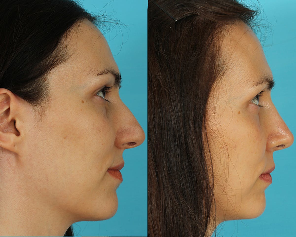 Rhinoplasty Before & After Gallery - Patient 297671 - Image 5
