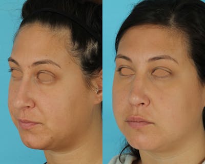 Rhinoplasty Before & After Gallery - Patient 166017 - Image 1