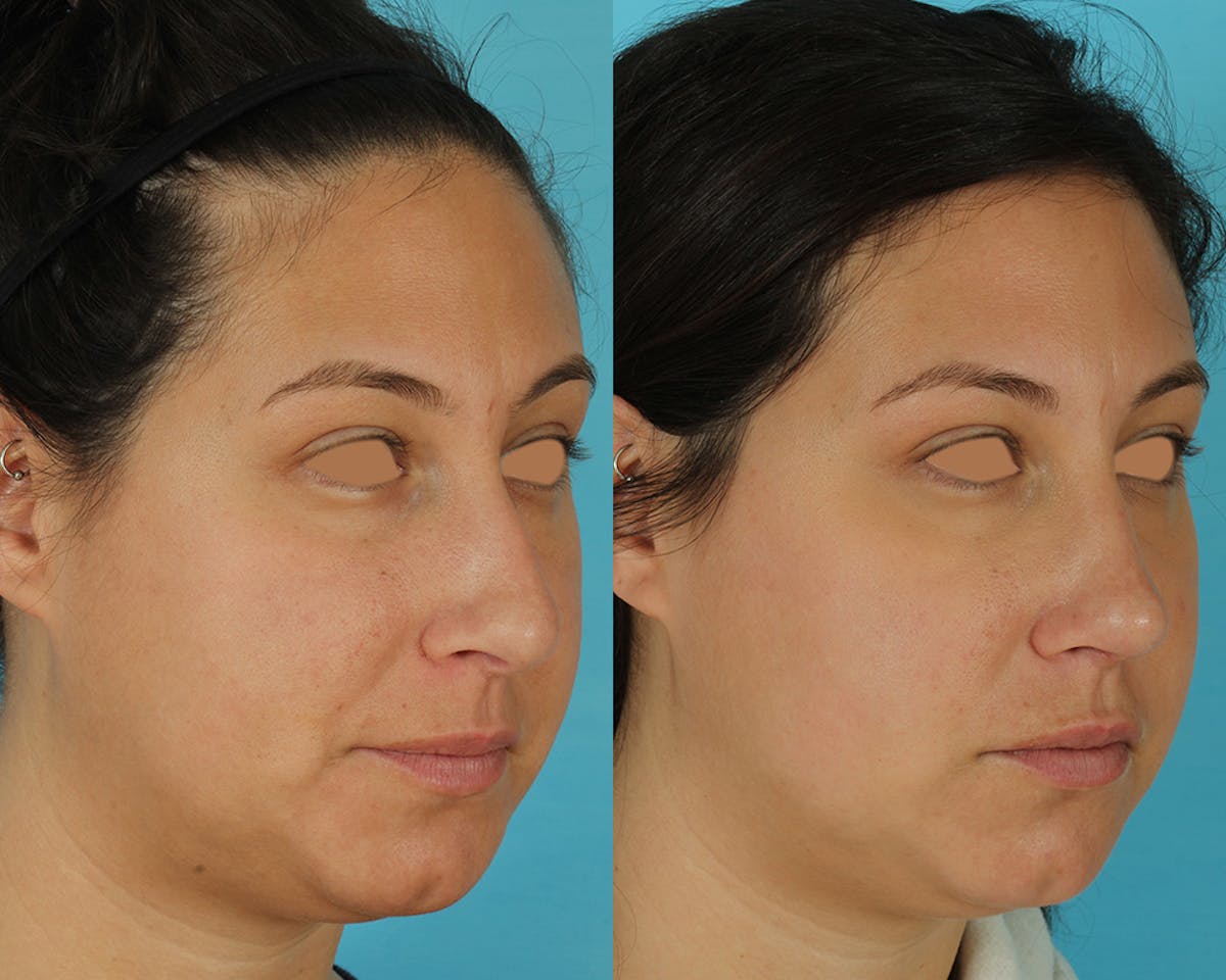 Rhinoplasty Before & After Gallery - Patient 166017 - Image 2